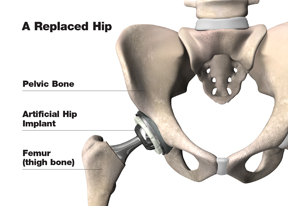 replaced_hip_w
